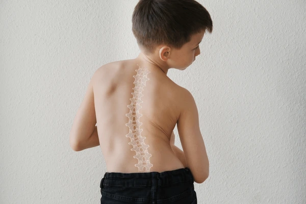 Escoliosis